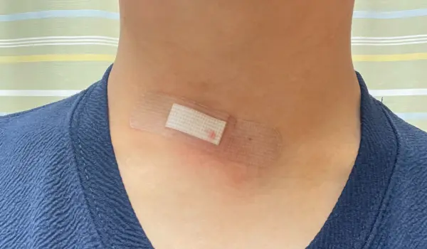 갑상선 석회화 갑상선 결절 세침시술 조직검사