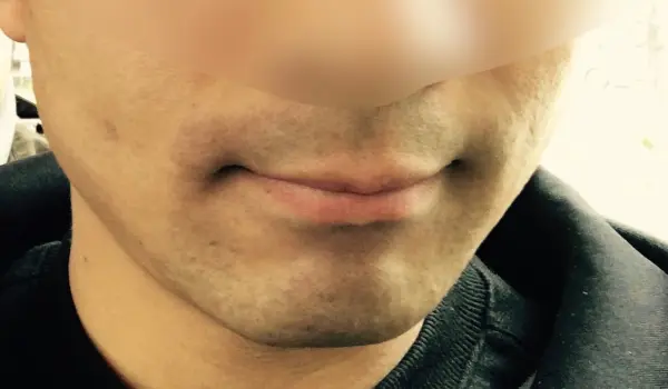 수염 레이저 제모 전 면도 오후