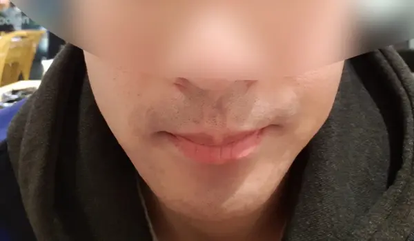 수염 레이저 제모 전 면도 직후