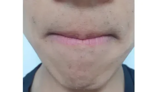22회 수염 레이저 제모 후기1