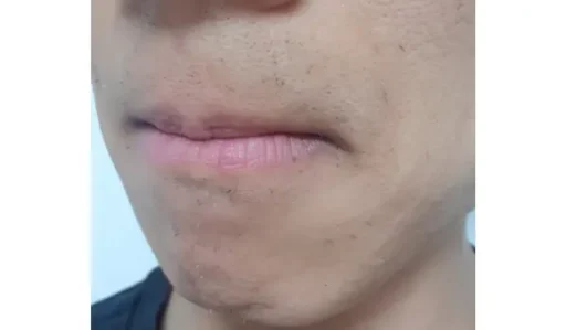 22회 수염 레이저 제모 후기2
