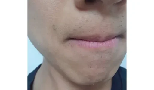 22회 수염 레이저 제모 후기3