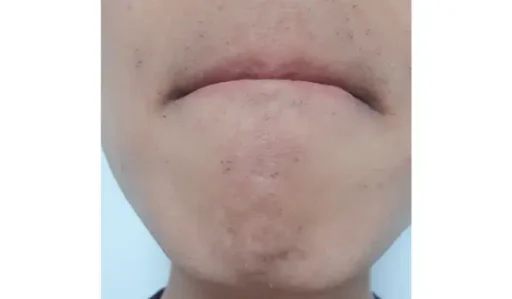 22회 수염 레이저 제모 후기4