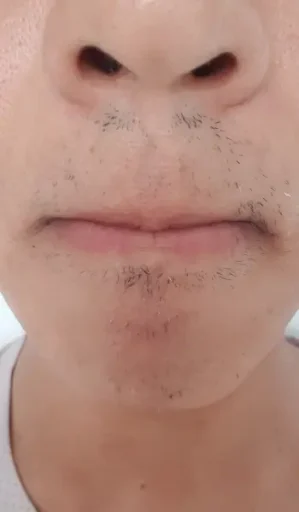 23회차 수염 레이저 제모 후기: 효과, 인증샷, 남은 수염 정리까지 2 23회차 수염 레이저 제모 남은 수염