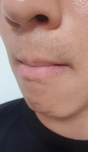 23회차 수염 레이저 제모 후기: 효과, 인증샷, 남은 수염 정리까지 3 23회차 수염 레이저 제모 후기 인증1