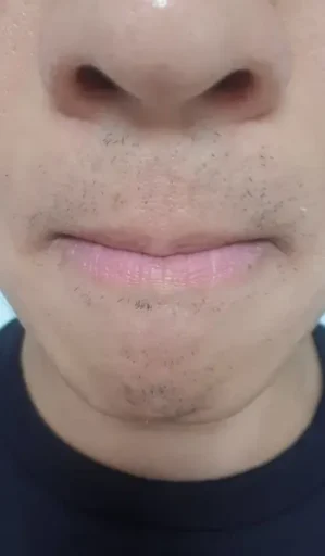 23회차 수염 레이저 제모 후기: 효과, 인증샷, 남은 수염 정리까지 5 23회차 수염 레이저 제모 후기 인증3