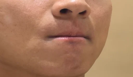 남자 수염 제모 몇 회가 필요할까? 24, 25회차 수염 레이저 제모 후기와 실제 변화 6 25회 수염 레이저 제모 후기1