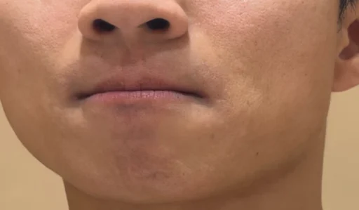 남자 수염 제모 몇 회가 필요할까? 24, 25회차 수염 레이저 제모 후기와 실제 변화 5 25회 수염 레이저 제모 후기2