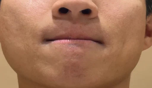 남자 수염 제모 몇 회가 필요할까? 24, 25회차 수염 레이저 제모 후기와 실제 변화 4 25회수염 레이저 제모 후기3