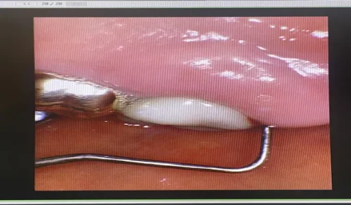 잇몸 염증 치료 후기 어금니 통증으로 치과 다녀온 솔직 후기 2 잇몸 염증 치료 후기