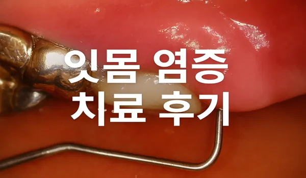 잇몸 염증 치료 후기 어금니 통증으로 치과 다녀온 솔직 후기 1 잇몸 염증 치료 후기 대표이미지