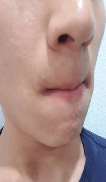 26회차 수염 제모 우측 사진