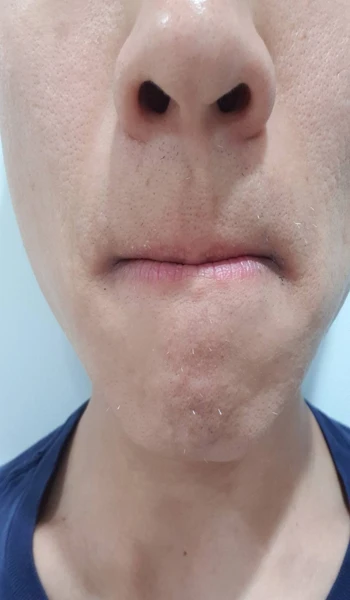 26회차 수염 제모 정면 사진