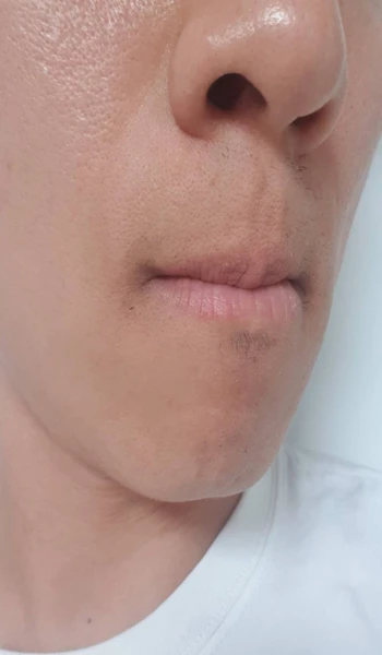 레이저 제모 후기 27회차 인증샷 우측