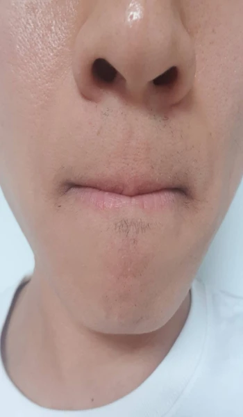 레이저 제모 후기 27회차 인증샷 정면