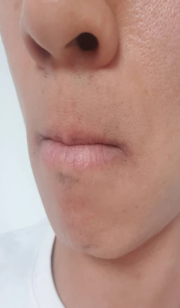 레이저 제모 후기 27회차 인증샷 좌측