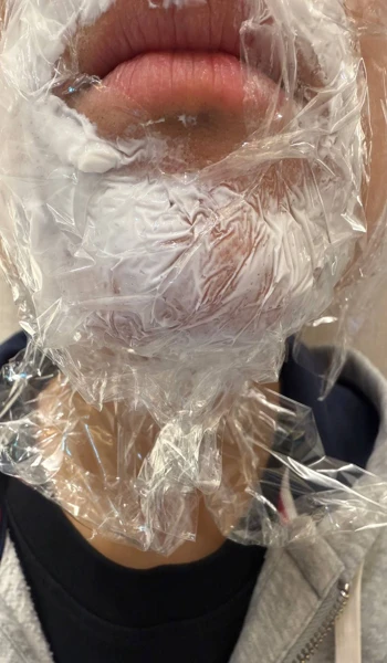 세라미크의원 강남 마취크림 턱 부분