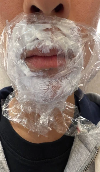 세라미크의원 강남 마취크림 바른 모습